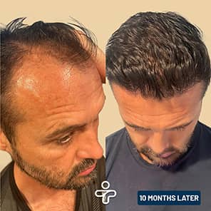 Haartransplantation Patient vorher nachher