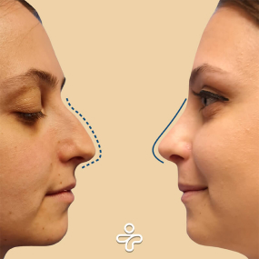 Antes de la Rinoplastia