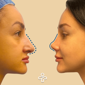 Después de la Rinoplastia