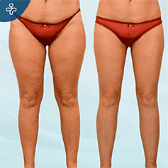 before-after-thigh-lift-scars