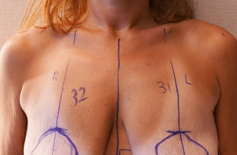 Womans chest with surgical markings before breast augmentation or lift procedure