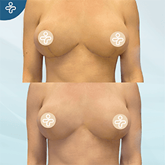breast-lift-scars-2