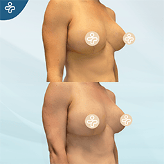 breast-lift-scars