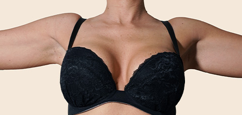 Woman with arms raised showing smaller, lifted breasts in black bra after breast reduction surgery in Turkey, front view.