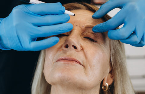 Surgeon marking forehead for brow lift procedure in Turkey to enhance youthful appearance