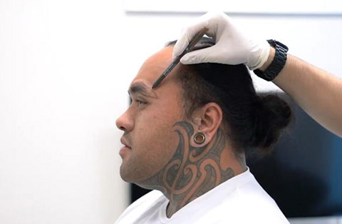 Male patient receiving pre-op eyebrow markings before transplant procedure
