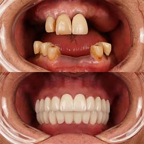 Patient dentaire avant après