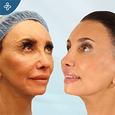endoscopic-facelift-2