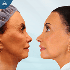 endoscopic-facelift-3