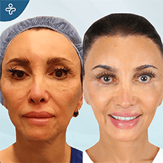 endoscopic-facelift