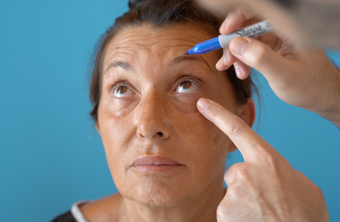  A surgeon marks a womans face during an eyelid surgery pre-op exam