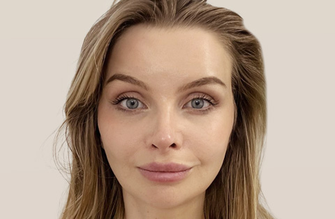 Frontal view of a woman after facelift surgery in Turkey showing smoother skin and youthful contours