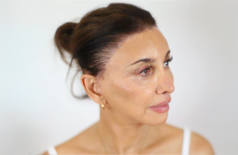 Middle-aged woman showing post-op results after forehead lift cosmetic surgery