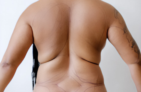 Back view of woman with sagging skin and surgical markings before liposuction