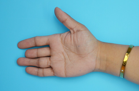 Hand showing full fingers after replantation surgery in Turkey, highlighting microsurgical reconstruction