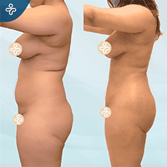 full-body-lift-3