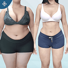 gastric-band-(1)