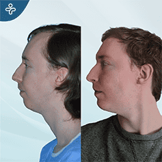 genioplasty-2
