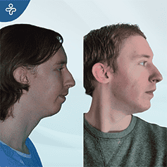 genioplasty-3