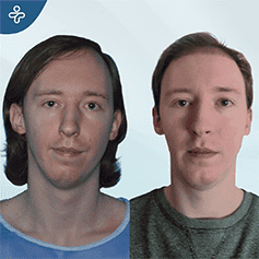 genioplasty