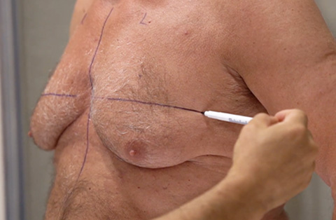 Surgeon marking male chest for gynecomastia surgery during pre-op examination