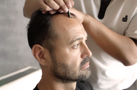  A male patient undergoes a pre-operative examination and hairline marking for a hair transplant procedure