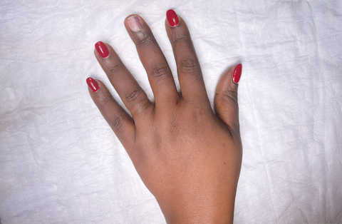 Top view of woman’s hand after reconstruction surgery in Turkey, showing restored finger and natural nail appearance.