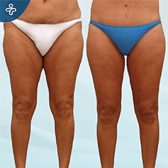 inner-thigh-lift-(1)
