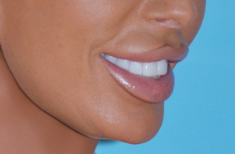 Close-up side view of woman’s lips after reconstruction surgery in Turkey, showing smooth and natural results.