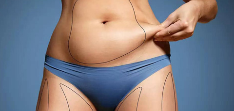 Woman pinching abdominal fat with treatment markings illustrating evaluation for liposuction candidacy