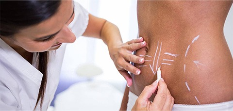 Surgeon marking patient abdomen for liposuction during body contouring consultation to assess treatment areas