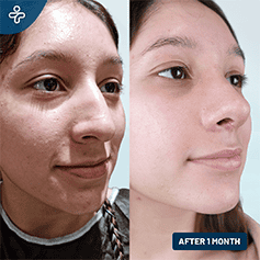 liquid-rhinoplasty-2