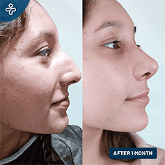 liquid-rhinoplasty-3