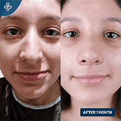 liquid-rhinoplasty