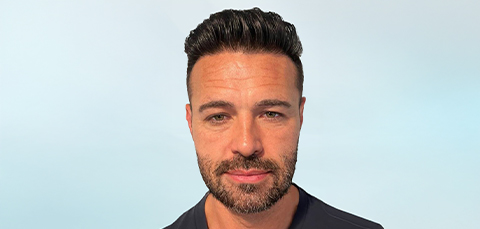 Man with receding hairline showing signs of male pattern hair loss, also known as androgenic alopecia