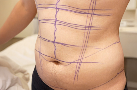 Male patient with pre-op markings on abdomen for six-pack abdominal etching surgery