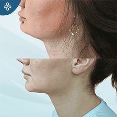 mentoplasty-(1)