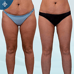mini-thigh-lift-(1)