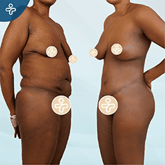 mommy-makeover-2