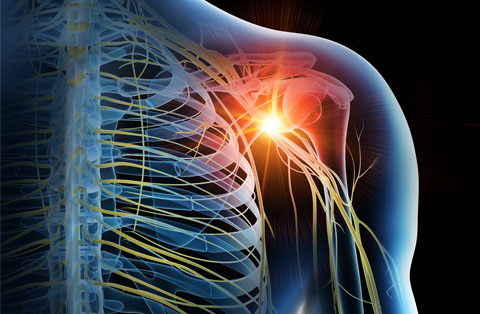 3D illustration of brachial plexus nerves with inflamed shoulder—target area for neurolysis to relieve chronic pain.