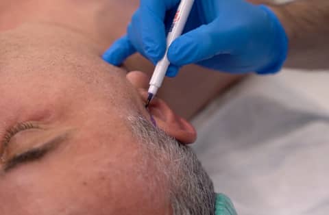 Surgeon in blue gloves marking behind male patient’s ear during otoplasty surgery examination