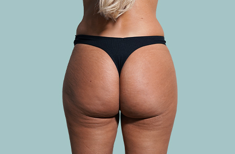 Woman showing post-op results of Brazilian Butt Lift with enhanced gluteal contour