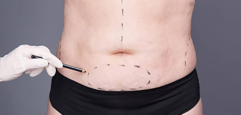 Surgeon marking abdomen for post pregnancy tummy tuck consultation to assess excess skin and abdominoplasty treatment