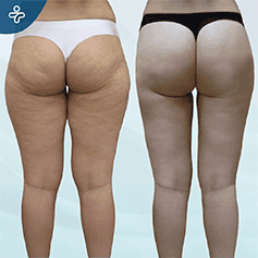 posterior-thigh-lift-(1)