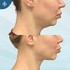 submentoplasty-(1)