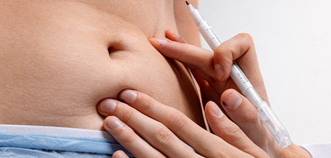 Surgeons hand uses a marker to mark the abdomen before abdominoplasty, focusing on the belly button area