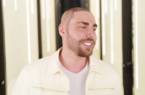 Smiling man with freshly outlined beard and hairline—showing immediate post-op results of a beard transplant procedure.
