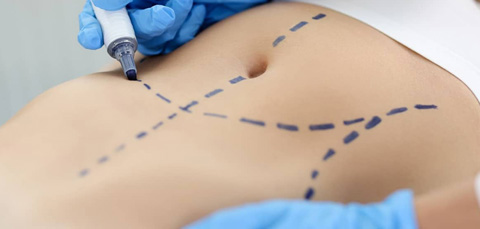 Surgeon marking abdomen before abdominoplasty illustrating risks and complications of a tummy tuck procedure