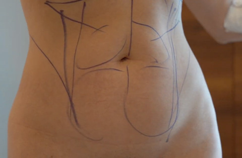 Close-up of abdomen with surgical markings before tummy tuck procedure