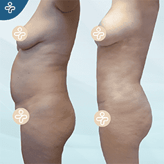 tummy-tuck-revision-2